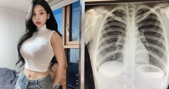 南韓「百萬網紅」不滿被質疑整形...曬 X 光照自證清白：我沒有動過手術