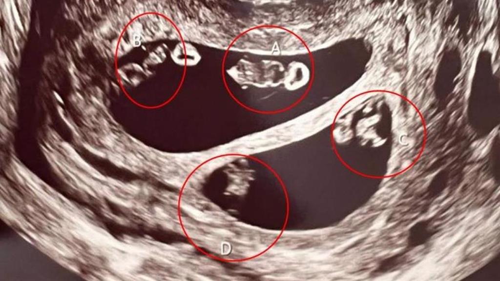 內斯產檢照超音波，醫生在螢幕內標記了四個點。(圖／翻攝自Instagram)