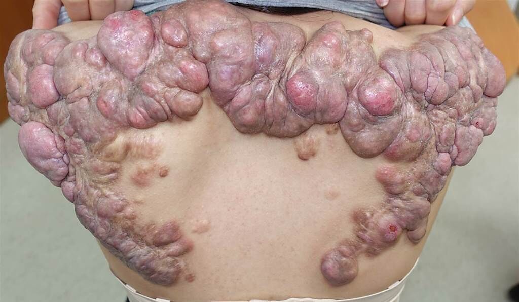 27歲的陳小姐，10多歲時背部長出2顆突起物，以為是青春痘，因不痛不癢，沒特別在意，後來的15年間，突起物蔓延愈來愈多。（圖／長庚醫院提供）