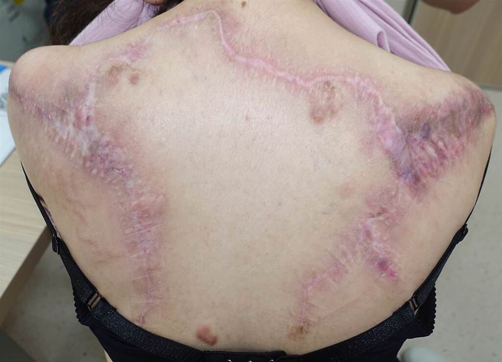 陳小姐背部嚴重蟹足腫經手術及放射治療後大幅改善。（圖／長庚醫院提供）