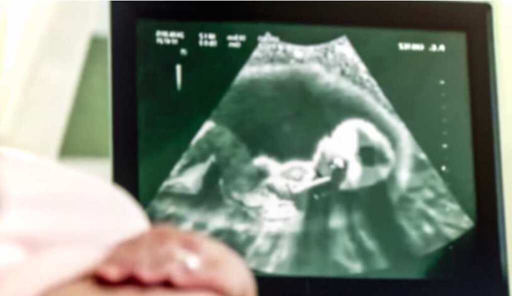 一名42歲3寶媽因為3個月生理期沒來緊張地到婦產科，一照超音波聽見胎兒心臟砰砰跳，讓她嚇傻因為老公已經結紮了。(示意圖 達志提供)