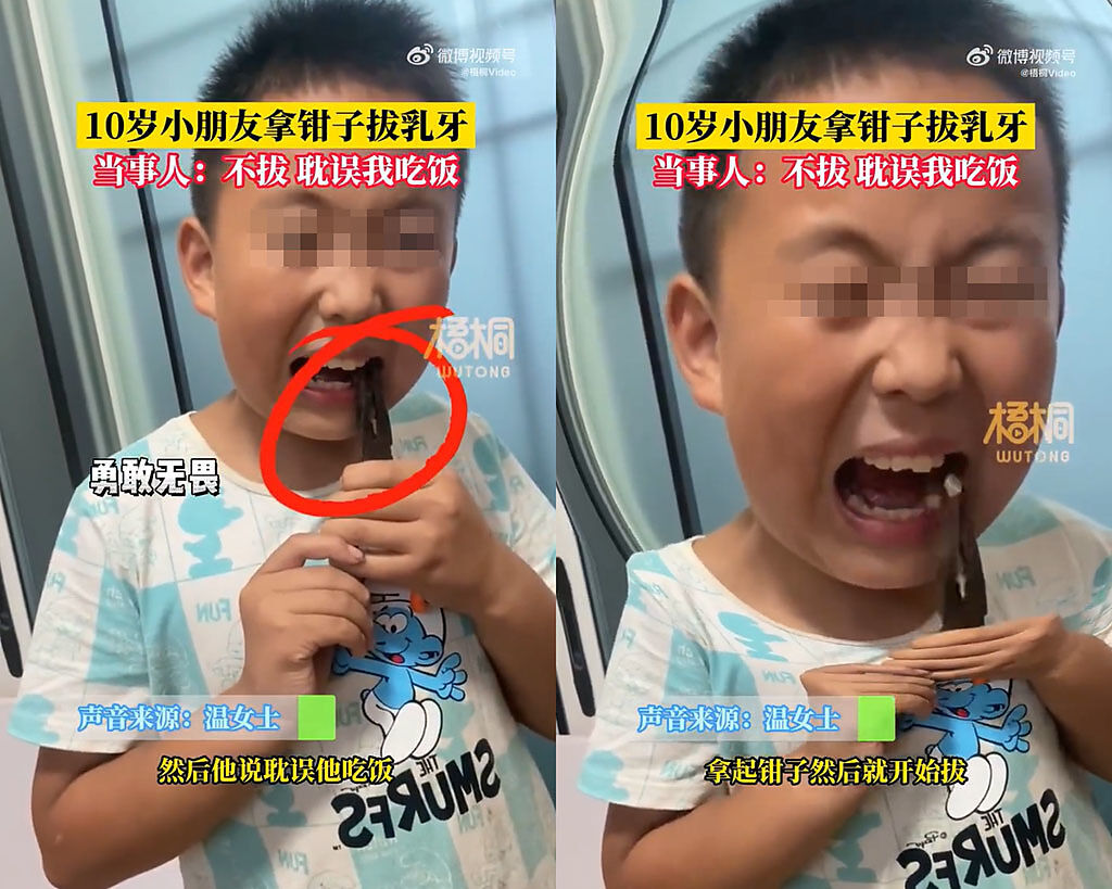 10歲男童吃飯時不滿鬆動的乳牙影響到他吃飯，便拿起鉗子自己拔。（圖／翻攝自微博）