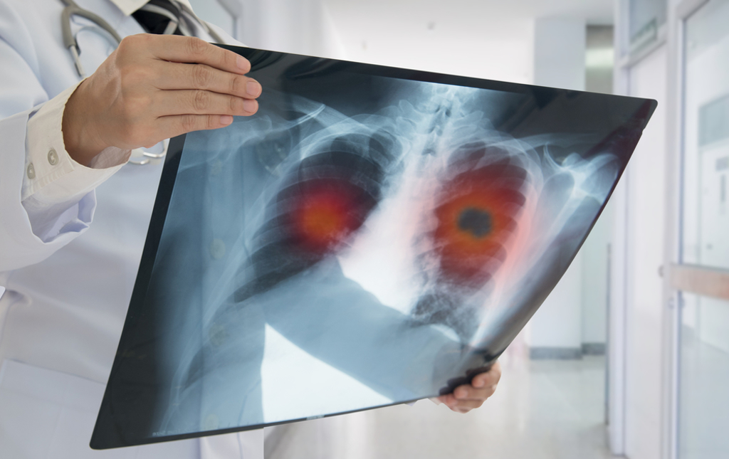 致死率最高的癌症為肺癌。（示意圖/翻攝自Shutterstock）