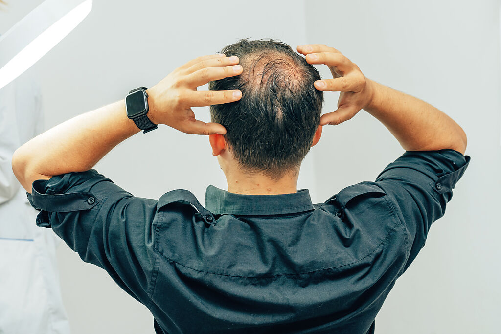 大量掉髮、甚至禿頭是許多人的困擾，也容易讓人頓時變大叔。( 示意圖/ Shutterstock )