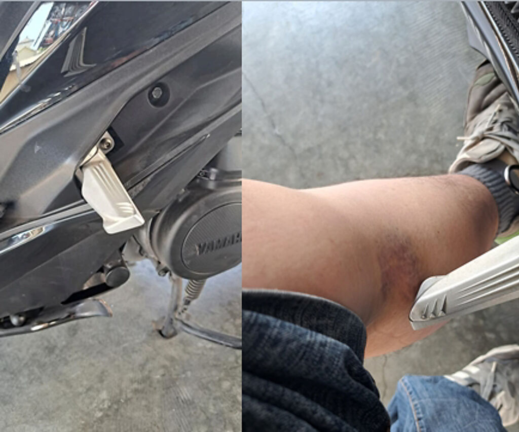 一名網友秀出撞到機車飛旋踏板的照片，小腿肚上出現大片瘀青。（圖／取自爆廢公社公開版）