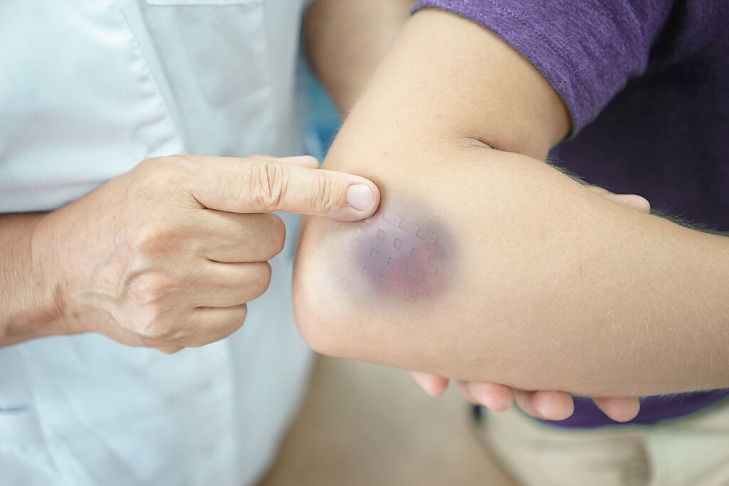 生活中難免會遇到扭傷、撞傷造成瘀青的困擾，到底該冰敷還是熱敷，常令人一頭霧水。( 示意圖/ Shutterstock )